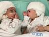 Вперше побачилися: в Ізраїлі розділили з'єднаних головами близнючок