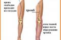 Тромбоз: симптомы, лечение и меры профилактики