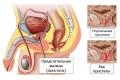 Рак предстательной железы: причины, симптоммы и лечение