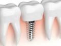 Підготовка до імплантації зубів: важливі кроки перед операцією