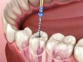 Особливості застосування стоматологічних ендомоторів