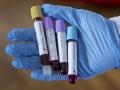 Украина обеспечена тест-системами для выявления коронавируса- Минздрав