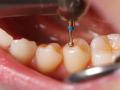 Як перестати боятися лікувати зуби та, нарешті, почати це робити?