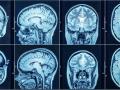 У чому різниця між КТ і МРТ: розповідає нейрохірург