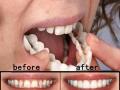 Как отбелить зубы за одну минуту