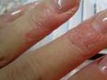 Вызывает ожоги и аллергию: чем опасен некачественный гель-лак для ногтей
