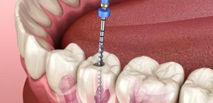 Особливості застосування стоматологічних ендомоторів