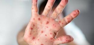 В Минздраве рассказали о ситуации со вспышкой кори в Украине