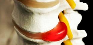 Нейрохирург объяснил, почему с грыжами в спине не стоит бежать «под нож»