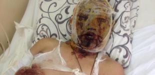 Обожженный танкист-бурят рассказал, что его батальон делал под Дебальцево