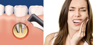 Методы лечения кисты зуба: есть ли шансы на спасение зуба