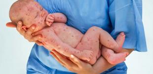 В Украине заболеваемость корью снизилась на 15%