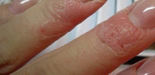 Вызывает ожоги и аллергию: чем опасен некачественный гель-лак для ногтей