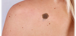 В «Ранку з Україною» врачи рассказали, как ухаживать за родинками и какие из них опасны