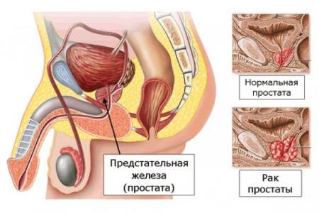 Лечение рака предстательной железы