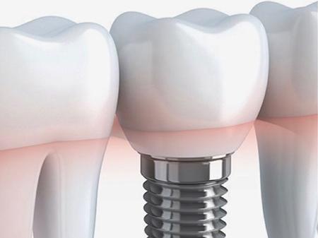 Eсть решение для вас: типы зубных имплантатов